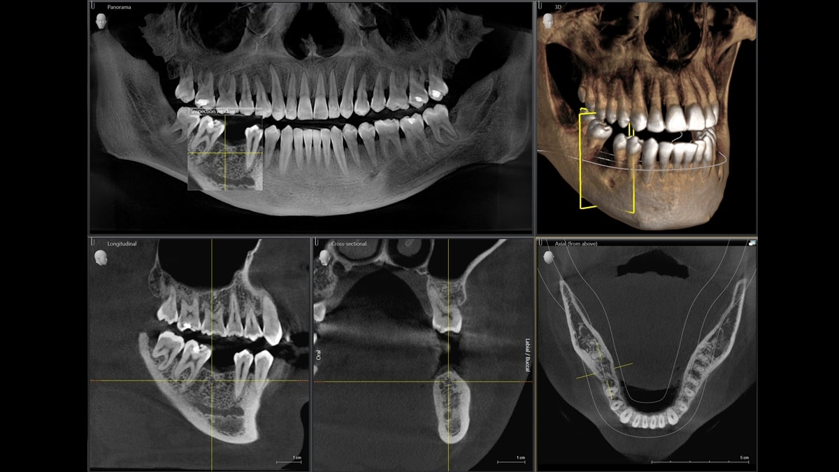 3d томография челюсти